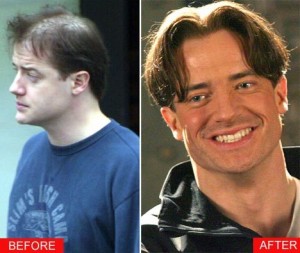 brendan-fraser-hair-loss-shampoo-zenagen