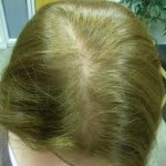 female-thinning-hair-hair-loss-celeb-hair-loss