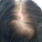 female-thinning-hair-hair-loss-celeb-hair-loss-3
