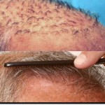 hair-loss-surgery-costs-celeb-hair-loss-1