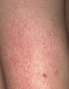 Keratosis Pilaris Dry Skin Information | Zenagen Blog | Zenagen ...